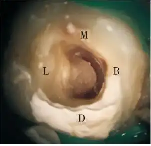 下颌第二磨牙c形根管根尖孔移位1例