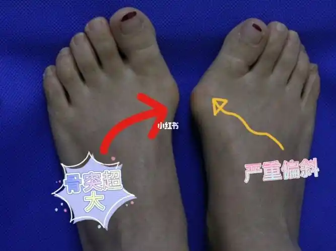 严重拇趾外翻#拇外翻#大脚骨治疗术后效果_拇外翻大脚骨_医疗健康