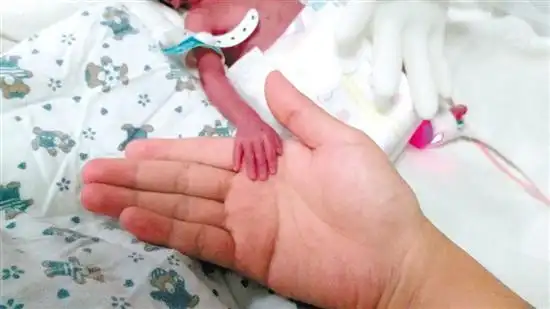 生命奇迹"超早产"双胞胎双双存活