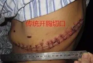 上图左侧示全胸腔镜手术,右侧示常规开胸手术,而术后的缝好的切口便会
