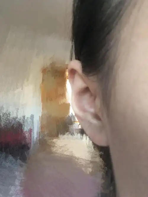 我这耳朵是耳轮外翻妈