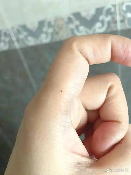 左手食指莫名其妙突然长个痣