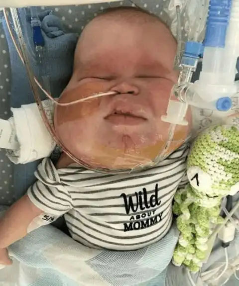 宝宝出生后哭不出医生建议放弃宝妈却相信奇迹的出现