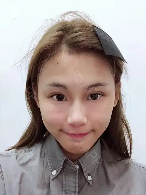 自体脂肪面部填充