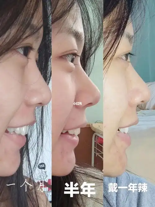 戴牙套第370天做对比图才发现变化这么大