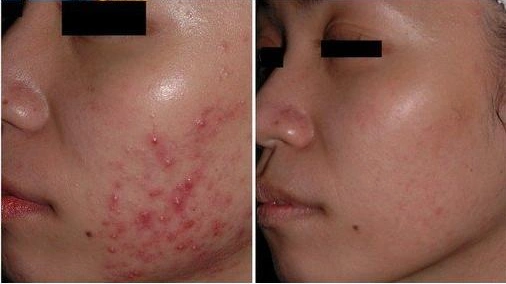 (祛痘前后对比)适应人群专家提醒激光祛痘印是因人而宜的,主要适应