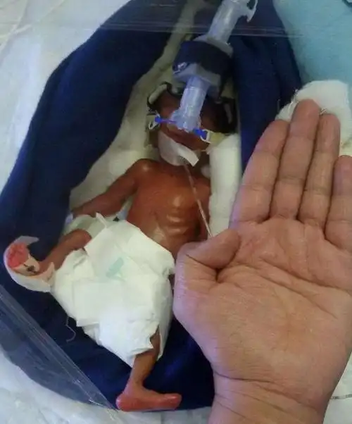 全球最小婴儿只有巴掌大小六个月后重获新生