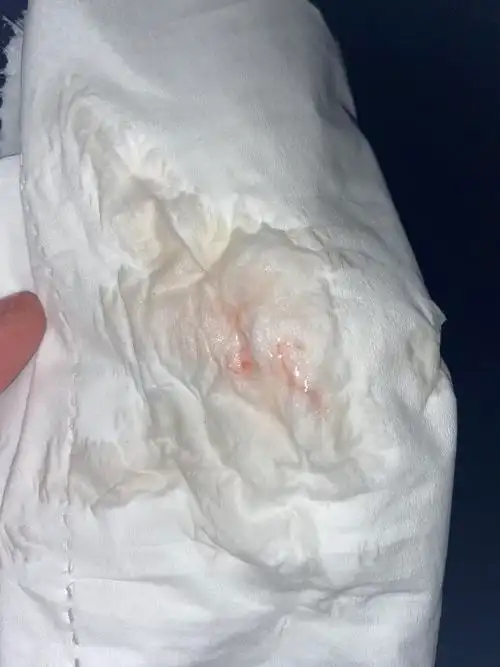 白带有血丝这是怎么回事