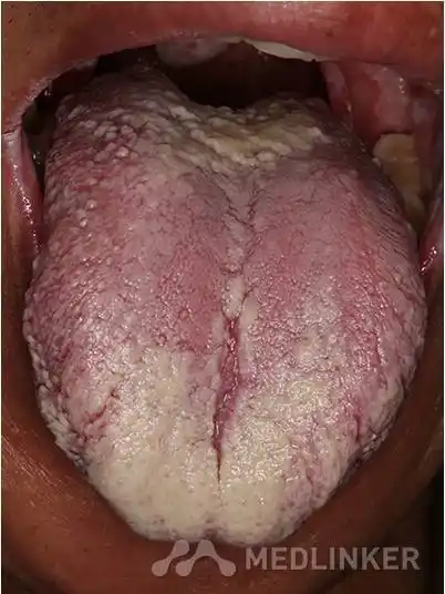 hiv感染相关的口腔念珠菌病2例