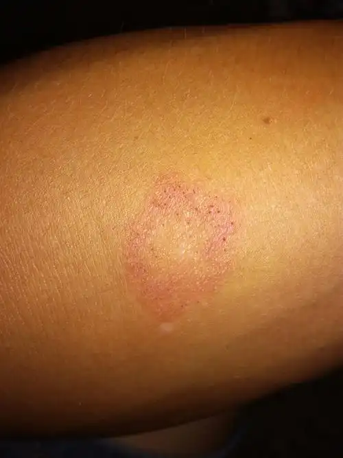 这是什么皮肤病