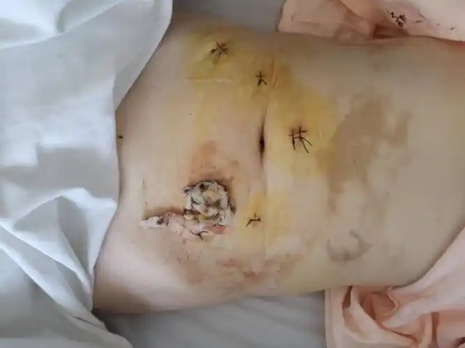 新技术一一腹腔镜辅助下直肠癌腹会阴联合切除术 写美篇会阴部手术组