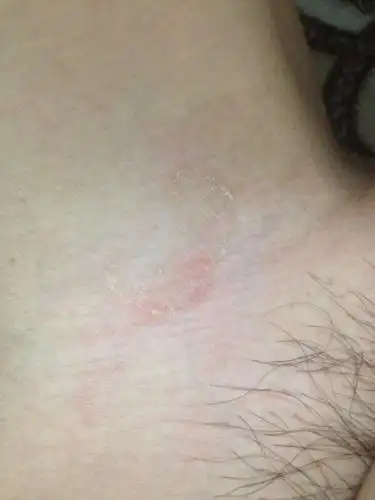 大腿根部起了一块翘皮,不疼不痒,微微发红