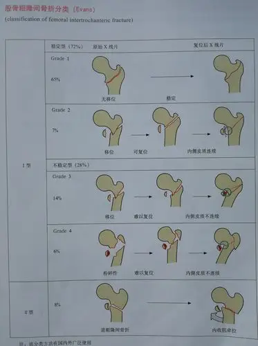 股骨粗隆间骨折国内,外常用的分型——evans分型