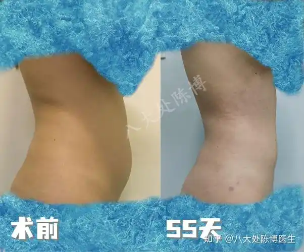 八大处陈博腰腹环吸案例持续更新