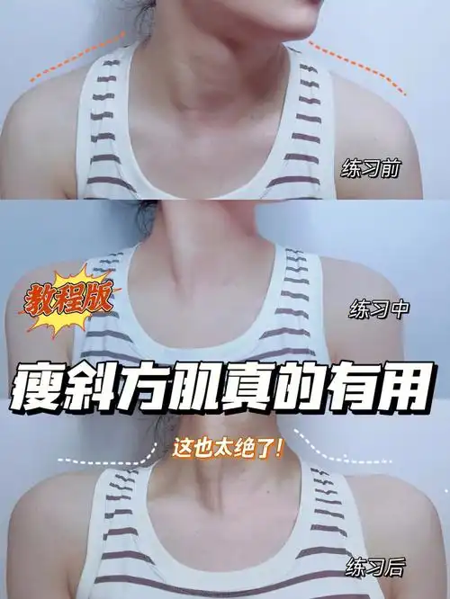 斜方肌对于女生来说真的太影响形象了,夏天来了,大家记得一定要多多瘦