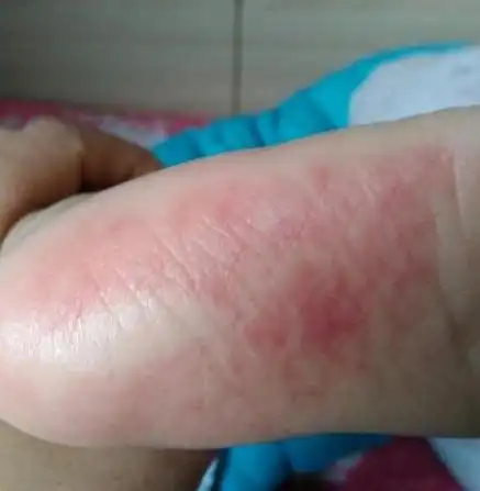 宝宝脚底板有红斑点是怎么回事