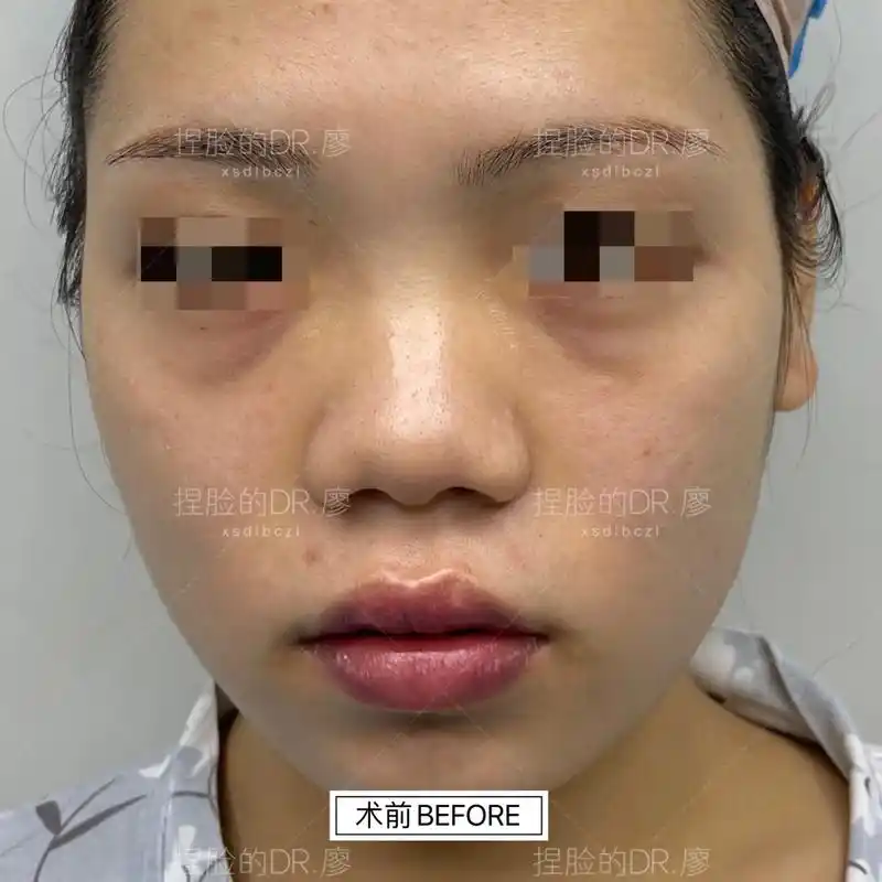 肋骨鼻综合缩鼻翼填鼻基底术后即刻分享