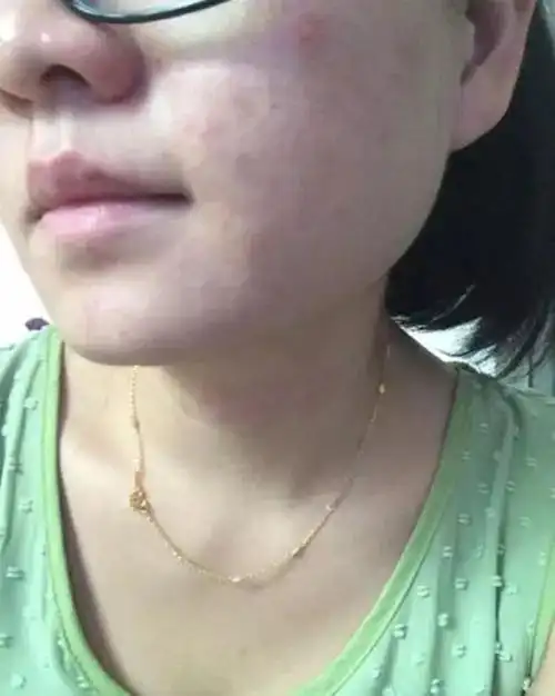 护肤品过敏的症状(化妆品过敏症状看这些)