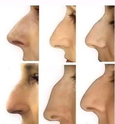 驼峰鼻颜值bug还是美的特色