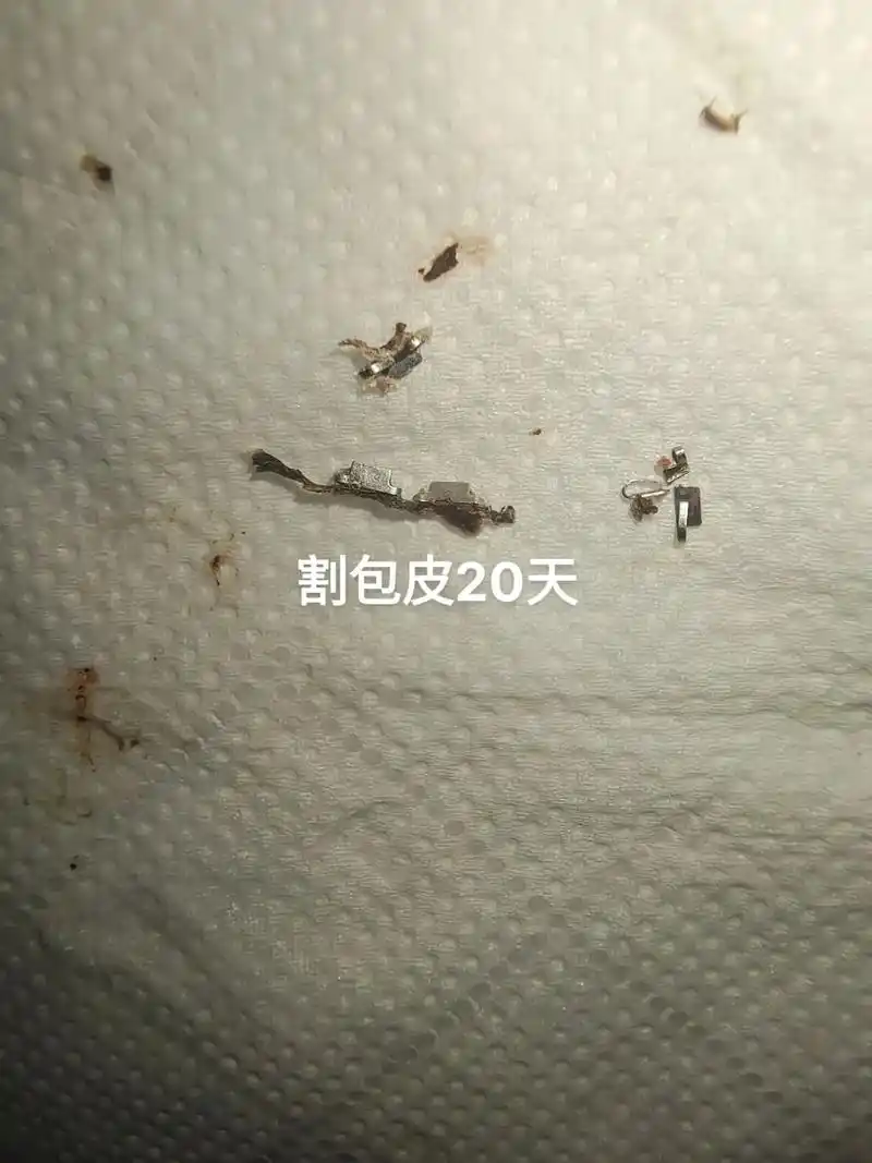 6月24做的吻合器手术现在7月14了恢复的还行我是第1代钉子掉有好几个