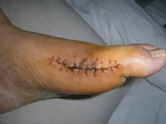 痛风结石清理手术 梁志军