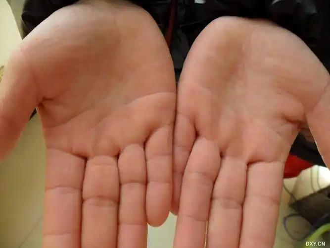 【病例讨论】掌跖点状角化症手背面也会有皮疹么?