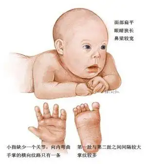 准妈妈坚持科学孕检避免唐氏儿