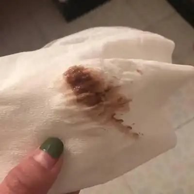 天了,前三天卫生间就出了红色的血,大前天上卫生间一出力就流了褐色的