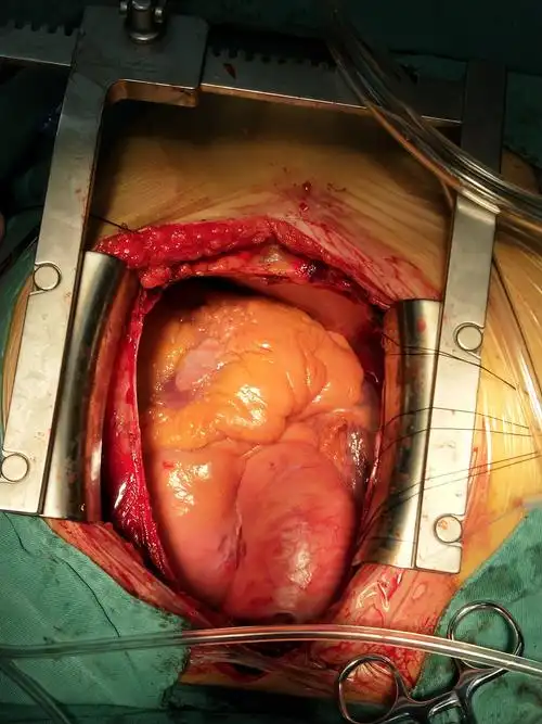 近日心外科成功救治一位牧区患者,顺利实施bentall 二尖瓣成型 动脉