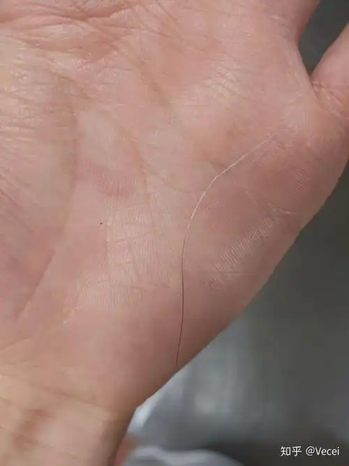 白头发还能长成黑头发吗?