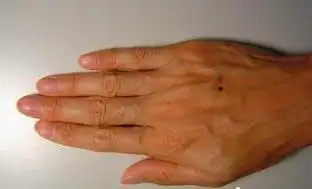 右手背有痣好不好右手背有痣代表什么