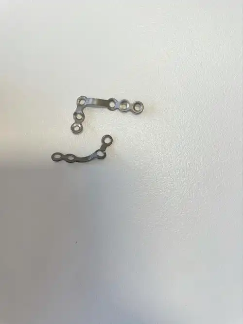 拆钉手术取下来的钉子图一是我的