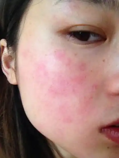 皮肤过敏又红又干