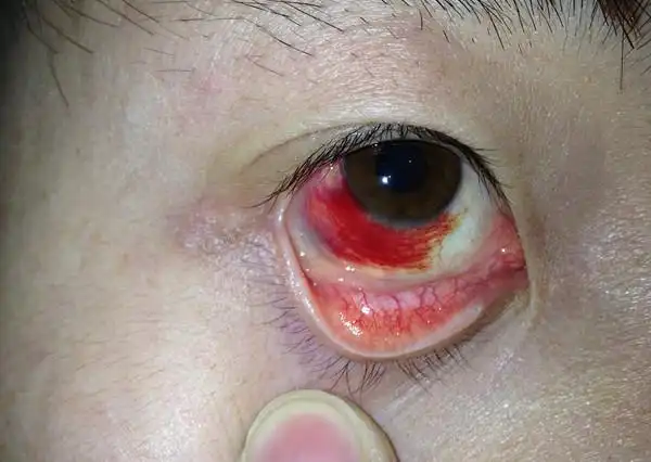 我右眼眼角边很红,已经有七八年了,最近特别痒,医生讲是结膜炎.