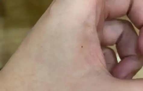 女人右手虎口有痣图解命运女人右手虎口有痣该不该去掉