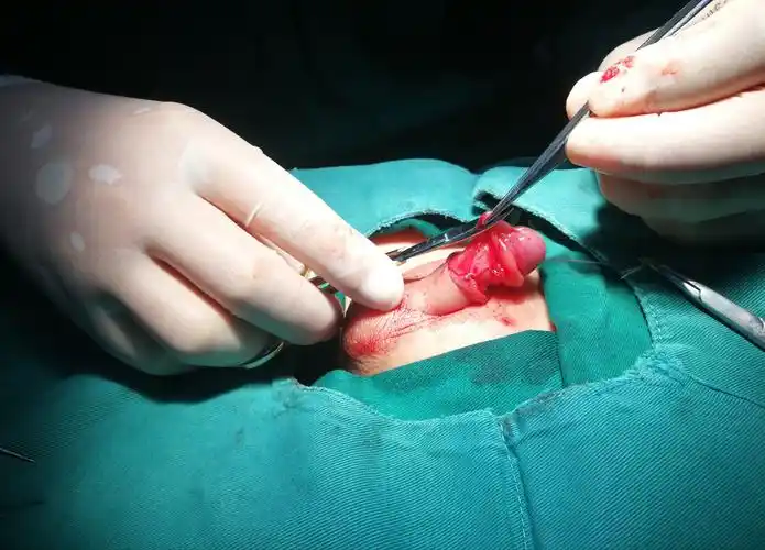 经包皮入路联合阴茎阴囊角重建隐匿阴茎矫形术