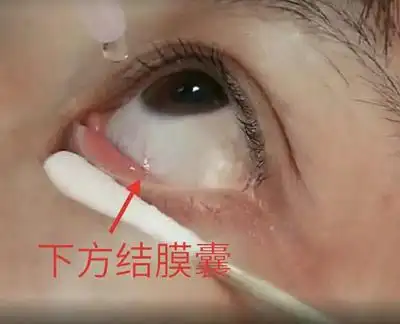 【科普】点眼药水小妙招 赶快来看看吧!