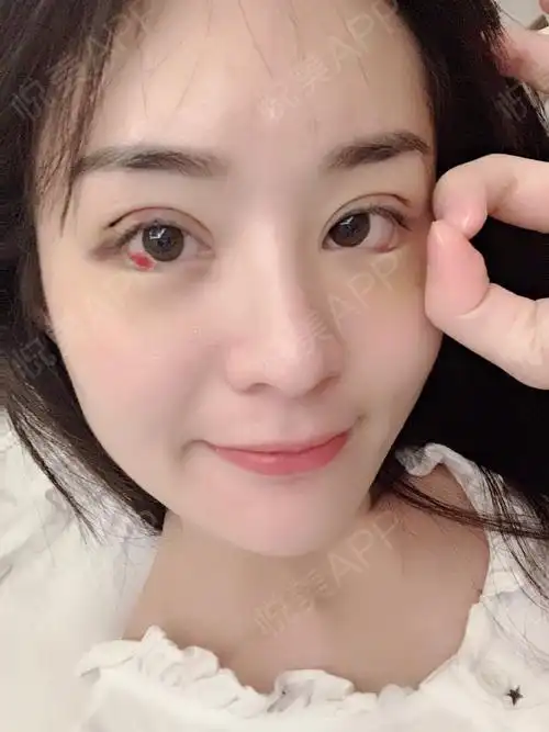 下睑下至术后7天_双眼皮修复术后7天_开外眼角术后7天_眼型矫正术后7