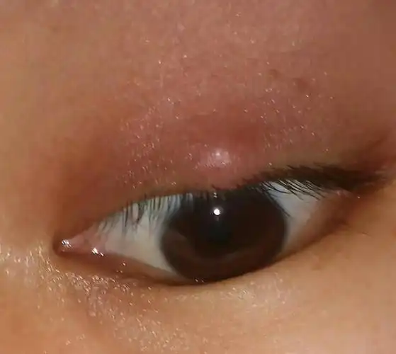 眼睛皮上长了这个,有时会有点痒,这是什么?