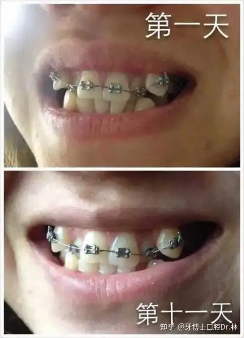 长了虎牙要进行矫正嘛? - 知乎