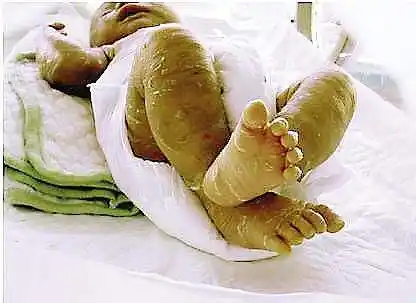 小腿上像鱼鳞一样是什么病该怎么治疗