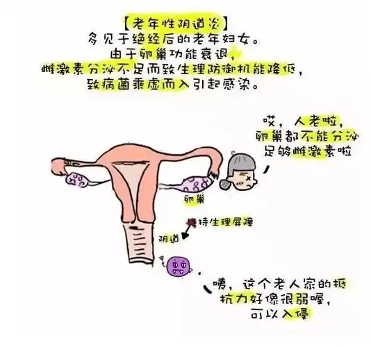 得了阴道炎会传染给伴侣吗?_滴虫