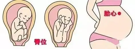 胎心在肚脐左下方是什么胎位