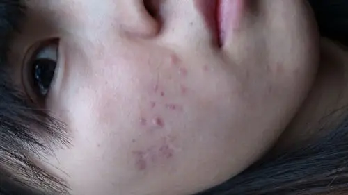 推荐答案 24 分钟前 1,建议您坚持使用暗疮皮肤专用的洗脸皂或洁面剂