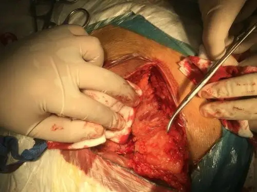 其它 一例藏毛囊肿切除limberg皮瓣转移术 写美篇 手术方式:藏毛窦