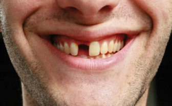 长期牙齿缺失可能引起的4种后果