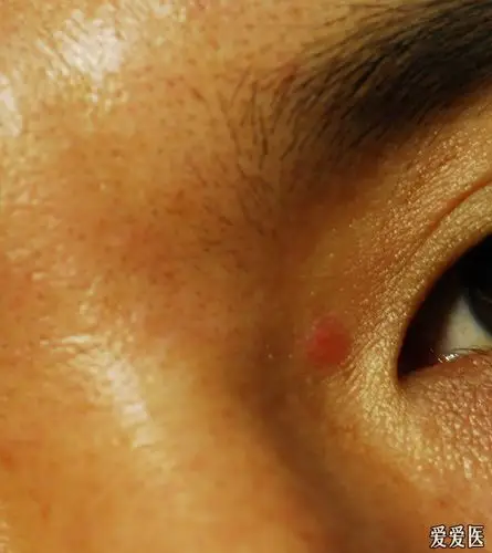 眼角有个小红疙瘩附图不痛不痒请问什么原因