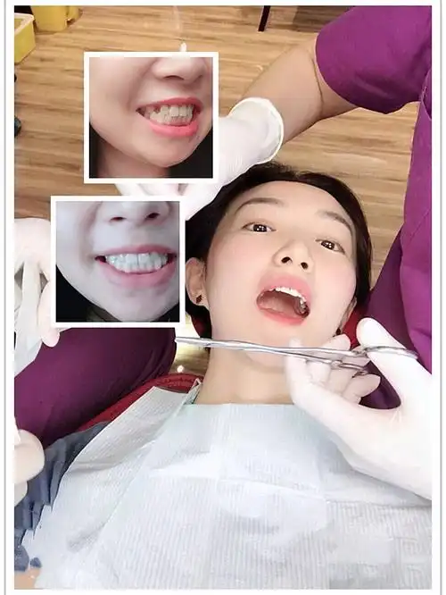 种植牙第三天全程分享记录一下种牙的过程像我这样牙齿_圈子-新氧美容