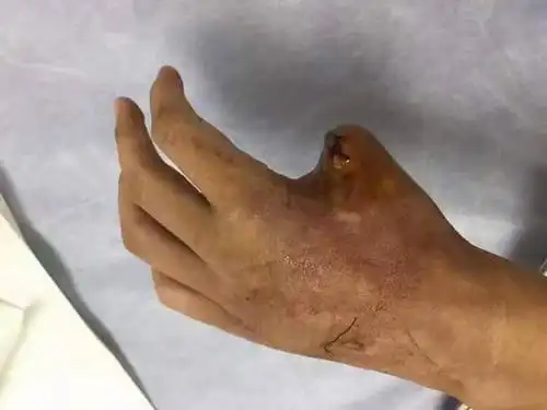 有没有一种蛇咬到人的手,他的手就会溃烂掉