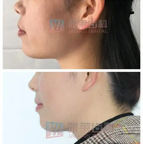 牙齿矫正前后侧面对比